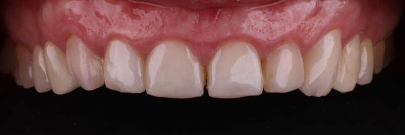 rekonstrukcja_okluzji-4546