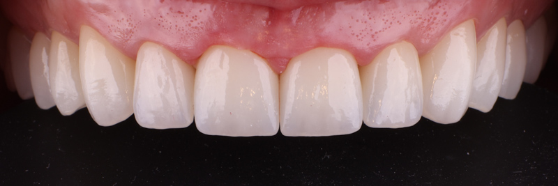 rekonstrukcja_okluzji-4989